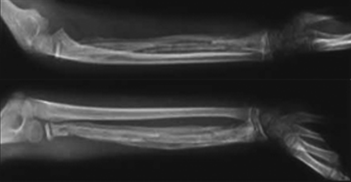 Osteomielite Tratado De Cl Nica Pedi Trica