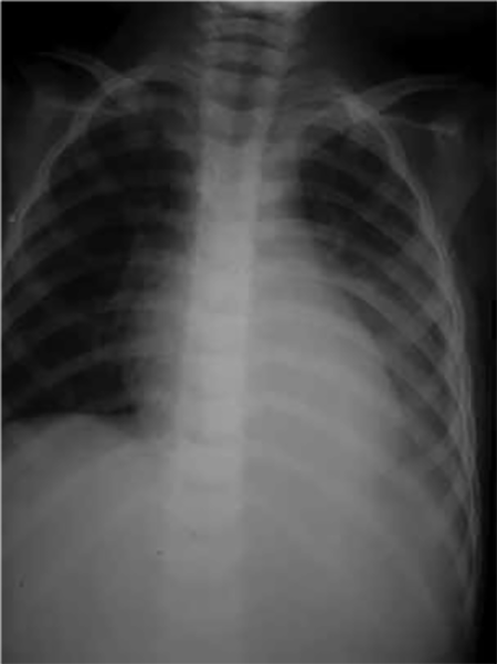 Derrame Pleural Tratado De Cl Nica Pedi Trica