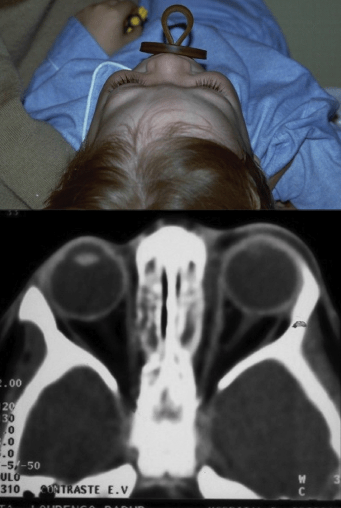 Celulites orbital e pré-septal - Distúrbios oftalmológicos - Manuais MSD  edição para profissionais