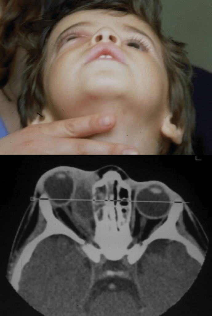 Celulites orbital e pré-septal - Distúrbios oftalmológicos - Manuais MSD  edição para profissionais