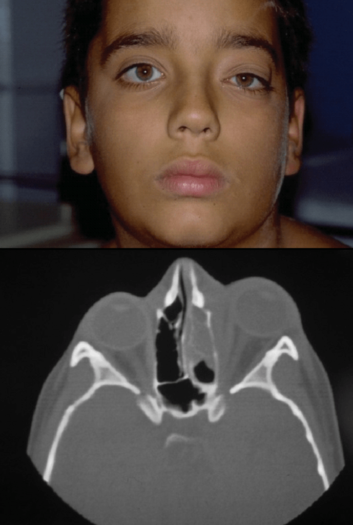 Celulites orbital e pré-septal - Distúrbios oftalmológicos - Manuais MSD  edição para profissionais